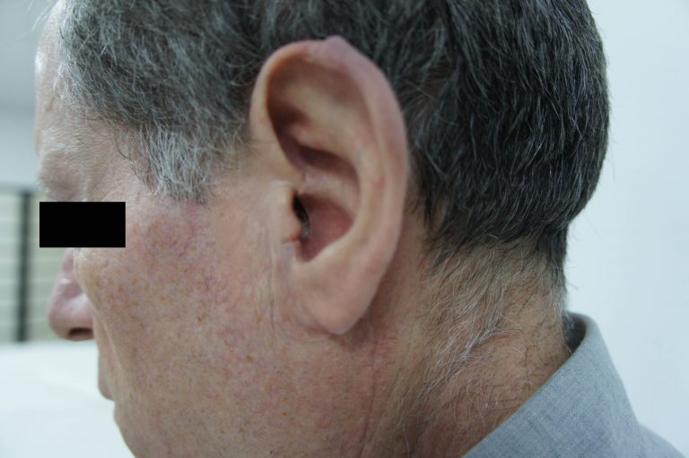 Prothèse de l'oreille