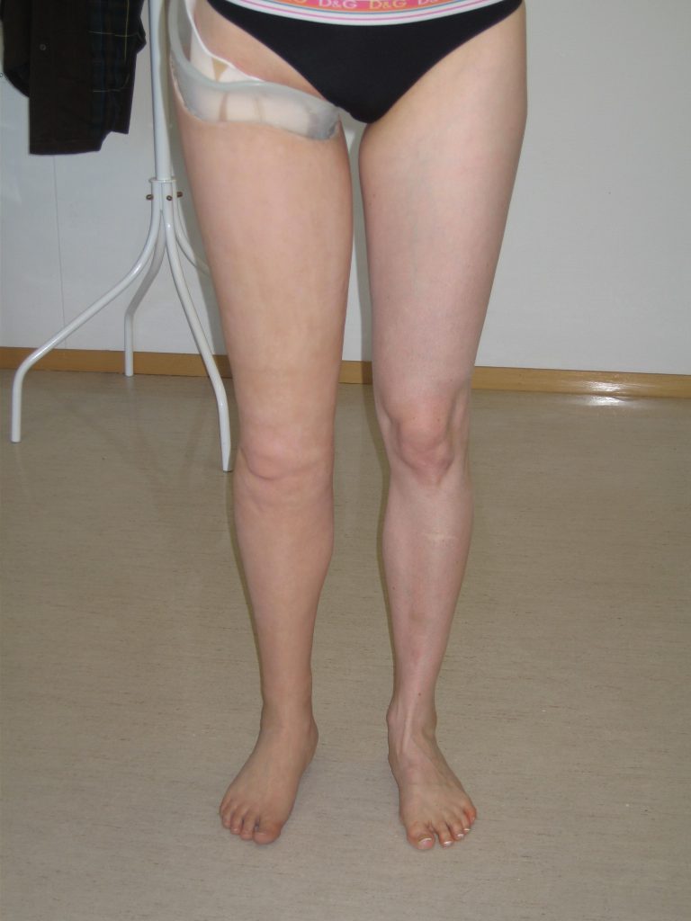 Prothèse jambe ahp europe