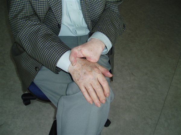 Prothèse partielle de la main