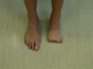 Prothèse de pied