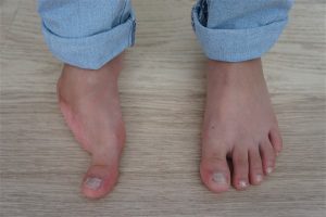 Amputation partielle de pied